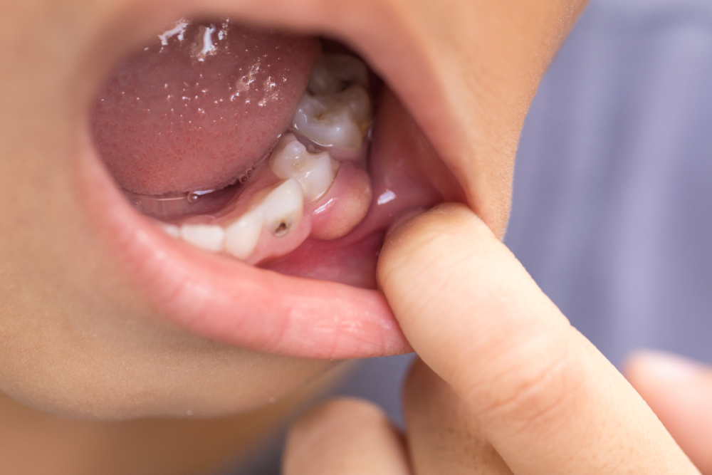 молочные зубы у детей выпадение