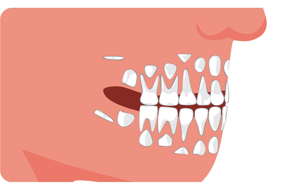 выпадение молочных зубов