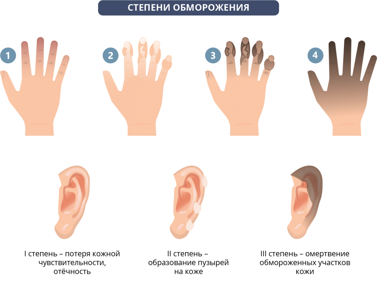 Обморожение картинки для детей