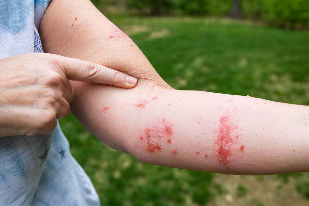 poison ivy rash stages