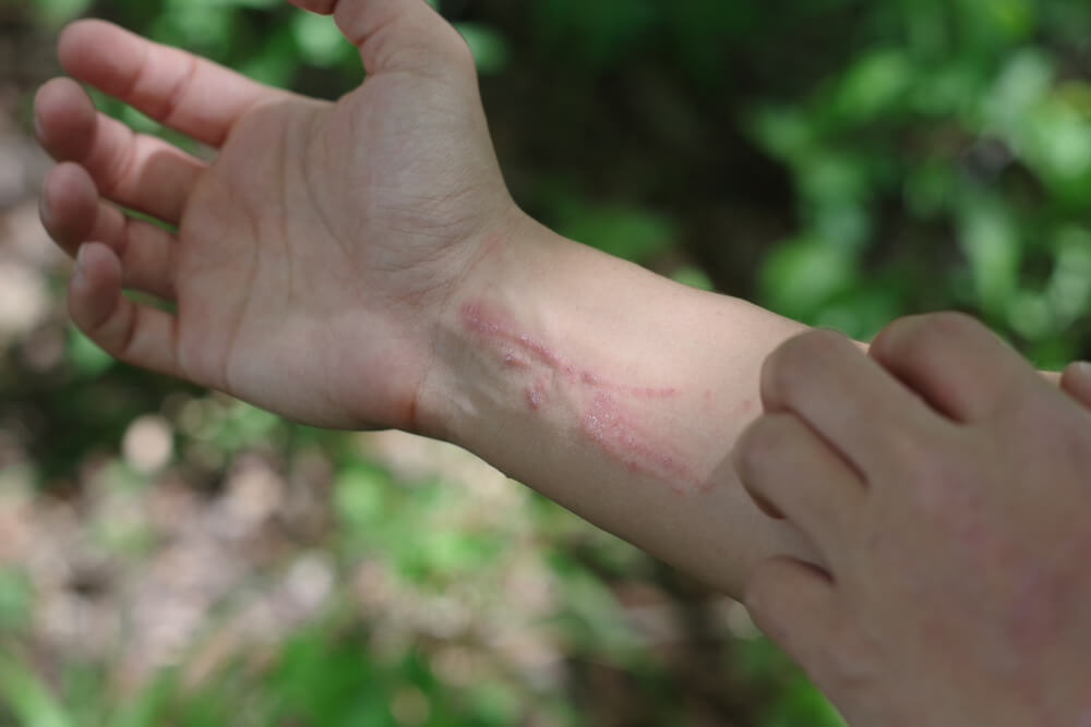 poison hemlock rash